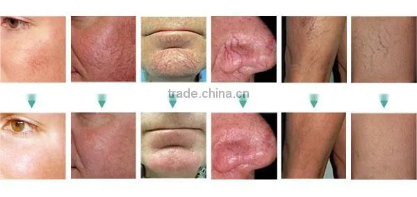 Pain Free Skin Mole Removal Machine photo-4