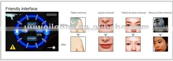 Q-switched Ndyag Laser,professional for Tattoo,pigment ,eyebrow Removal photo-4