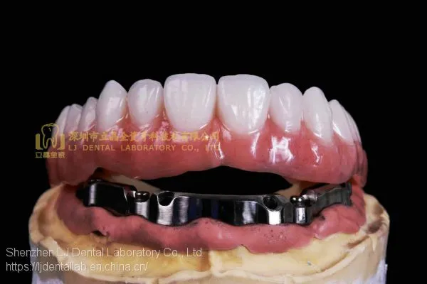 Dental Implant Bar, Implant Overdenture, Implant Prosthesis, Laboratoire Dentaire, Dentallabor, Laboratorio Dental, Dental Laboratory, Shenzhen LJ Dental Lab China photo-3