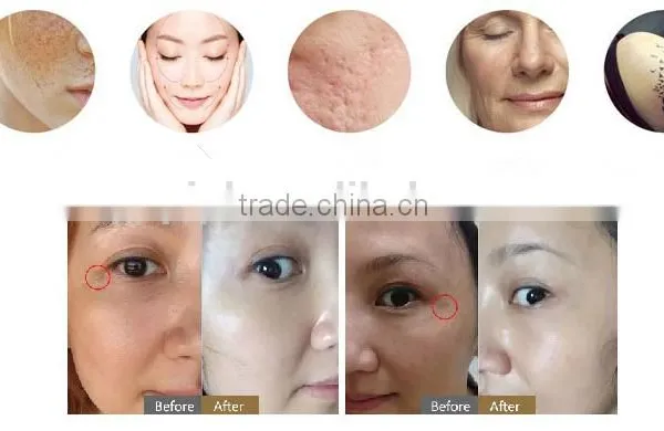 3in1 Machine Best Professional Multifunction Picos Laser Machine photo-2