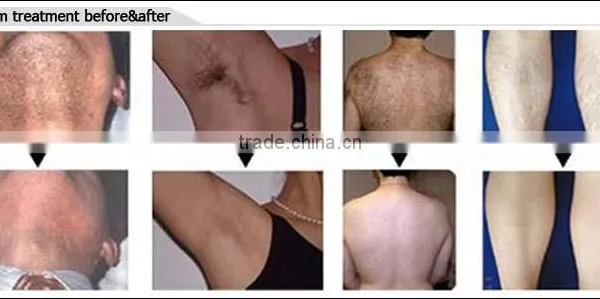 CE Approved Best-selling 10 BARS Laser Yag Hair Removal Machine for Beauty Salon photo-2
