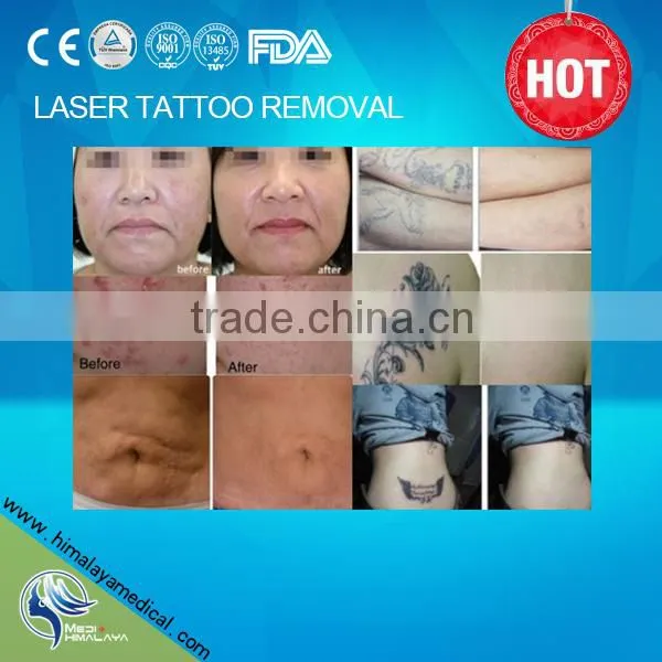 1064 nm 532nm nd Yag Laser Tattoo Pigmentation Removal Machine Stock photo-6