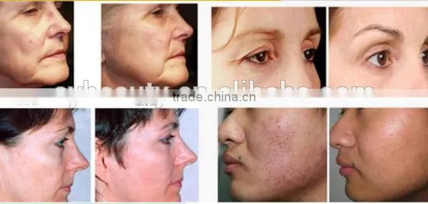 AYJ-M08 Home Use Microneedle Fractional Rf, Double Chin Removal Machine photo-6