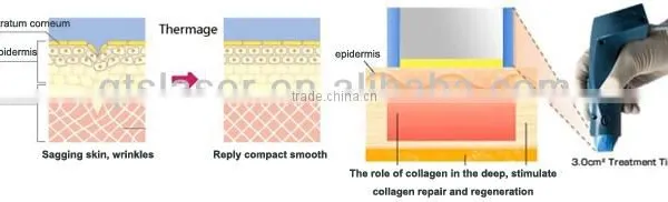 Companies Looking for Distributors in Africa Portable rf Cavitation / Fraction rf photo-2