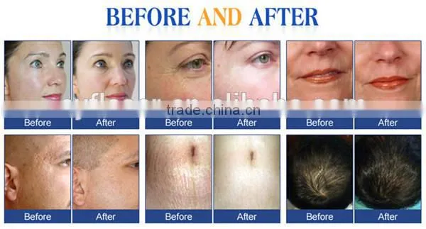 Derma Rollers For Acne Scars Body Dermaroller Derma Rolling Microneedles For Face System Derma Equipment 2.5mm photo-4