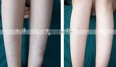 Multifunction Portable Ipl Shr Breast Lifting Up Laser Hair Removal Machine photo-4