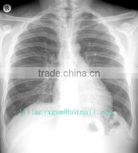 Laser Printing Medical Dry Film