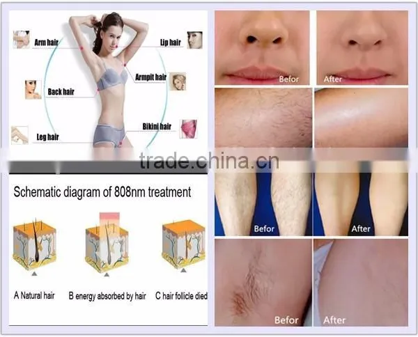 50-60HZ Newest 808nm Diode Laser Hair 1-800ms Removal Machine/808nm Diode Laser Hair Removal photo-5