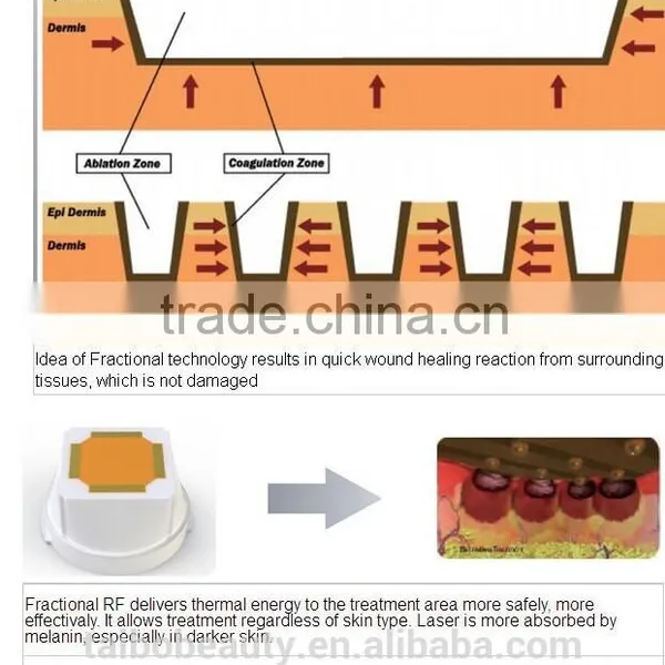 Professional Microneedle Rf/best rf Skin Tightening Face Lift Machine/micro rf Deep Wrinkle Removal photo-5
