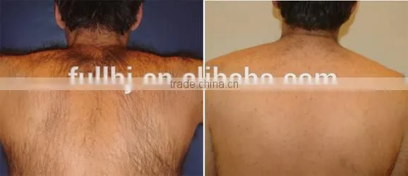 1500mj Vertical ND YAG Long Pulse Laser No Pain Hair Removal Beauty Machine 0.5HZ photo-6