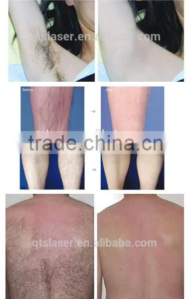 755 Alex Laser ,Hair Removal & Skin Rejuvenation Alexanderite Laser Machine photo-4