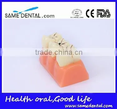 4 Times the Cavities Progress Model Dental Eduction Assitant No. DEA-16 photo-3
