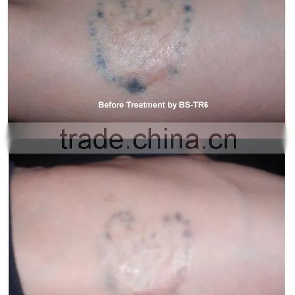 1 HZ Q Switch Laser Tattoo Removal Machine For Skin Tattoo Treatment 1-10Hz photo-3