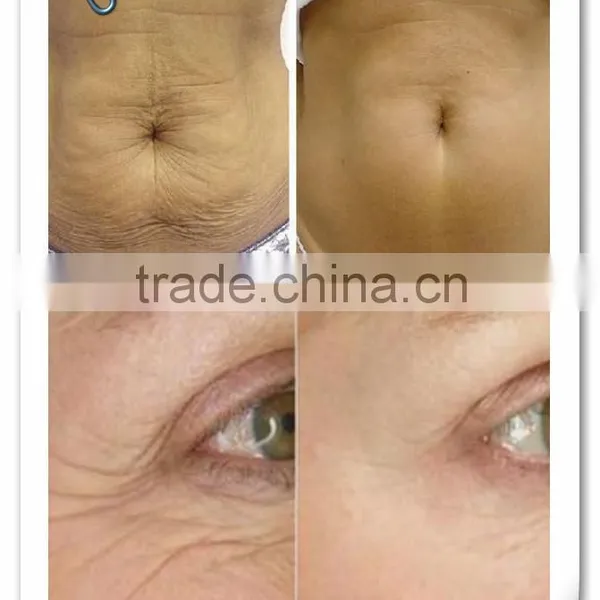 Advanced 2 in 1 Fractional Micro Needle RF Thermagic RF Microneedle for Deep Anti-aging and Wrinkle Removal photo-6