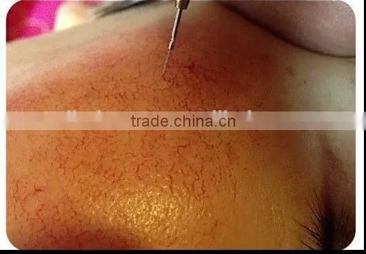 RBS Vascular Therapy Red Spider Veins Removal Machine With High Frequency photo-2