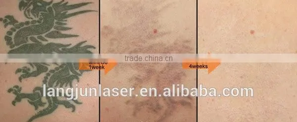 ND Yag Laser Tattoo Removal Machine Vascular Tumours Treatment Mini Q Switch ND Yag Laser MINI-C6 Tattoo Laser Removal Machine photo-5