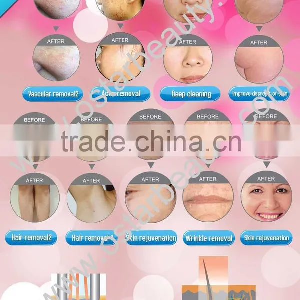 Vascular Lesions Removal 2 In 1 Elight Ipl Rf Face Lifting Beauty Care Equipment E 03 Skin Care photo-6