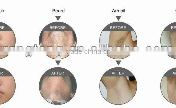 Promotion Machine SHR Machine Permanent Hair Removal photo-4