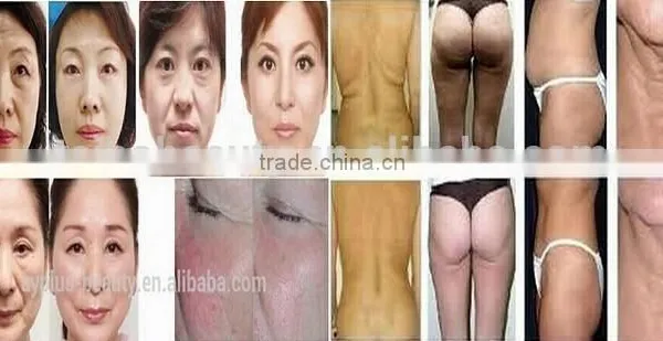 Ultrasonic Cavitation Radio Frequency Machine/ultrasonic Liposuction Cavitation Slimming Machine/ultra Non Surgical Ultrasound Fat Removal Slim Plus Ultra Cavitatio Weight Loss Equipment Slimming Machine photo-6