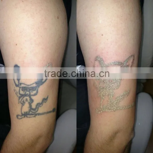 Professional Alexandrite Laser nd Yag Laser Tatoo Removal Laser With CE photo-6