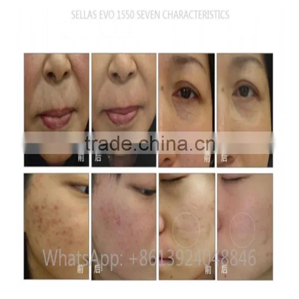 1550nm Anti-Aging Laser Stretch Marks Elimination Rejuvenation Therapy Machine 1550nm Laser Fiber Laser Machine photo-5