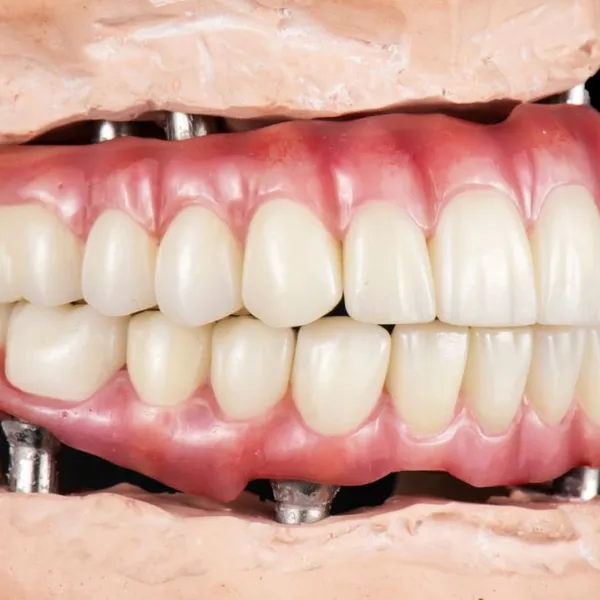 Metal Free FDA All Zirconia Crown OEM Implant Supported Dentures photo-3