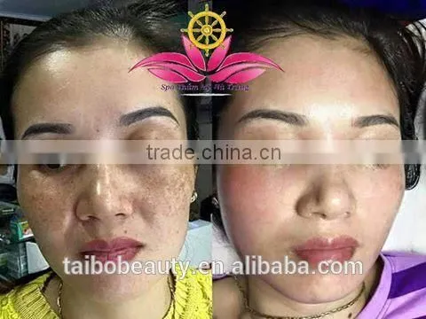 0.5HZ 2016 Professional Tattoo Removal Laser Machine Q-switched Nd Yag Laser/nd Yag Laser Prices/cosmetic Nd Yag Laser Machines Prices Q Switch Laser Tattoo Removal Machine photo-6