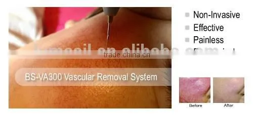 Painless Spider Veins Vascular Removal Machine photo-6