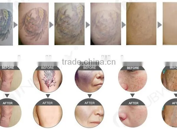 Big Pomotion !Professional Multifunctional Permanent Hair Removal Professional Laser Hair Removal Machine photo-5