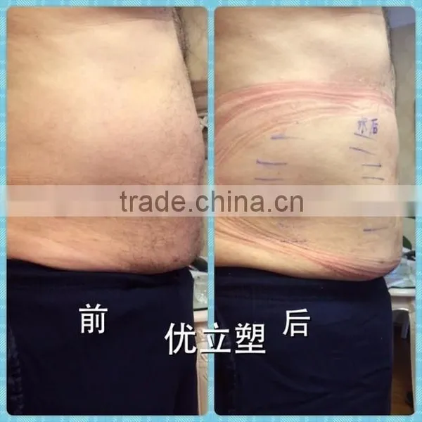 Ultrashape New Slimming Technology Machine Cavitation Slimming Machine photo-6