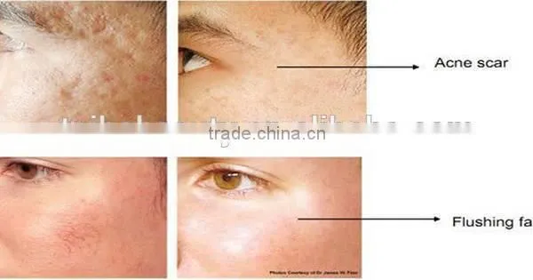 2016 Express Micro Needle rf / Fractional rf Microneedle Sale /radio Frequency Wrinkle Removal and Skin Rejuvenation photo-6