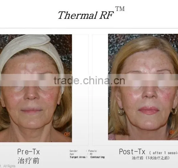 Fractional rf Micro Needling Wrinkle Removal Machine From Beauty Salon Equipment Supplier photo-5