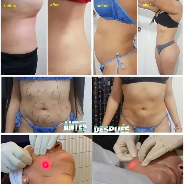 High Power Endolaser 1470nm 980nm Double Waves Diode Laser Face Lifting Liposuction Machine photo-3