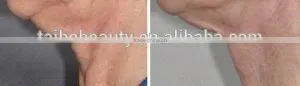 Home Use Fractional rf Microneedle Wrinkle Wipe Out Device photo-6