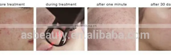 0.1-2.6mm Hottest Selling Laser Co2 Acne Scar Removal 10600nm /medical Fractional Co2 Laser Machine Birth Mark Removal photo-6