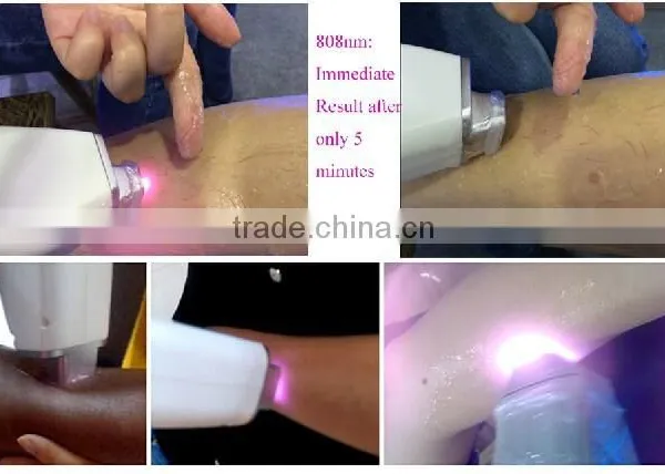 2015 Sell Hot Laser Diodo 808nm Machine for Painless Hair Removal photo-6
