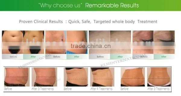 NIR Laser Vacuum RF Electrodes Skin Smoothing Tightening photo-4