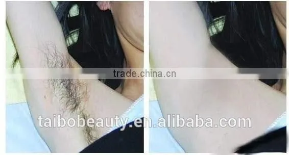 Technical E-light Ipl Shr Hair Removal Laser Machine/super Hair Removal 3 in 1 IPL Machine for Spa and Clinic photo-6