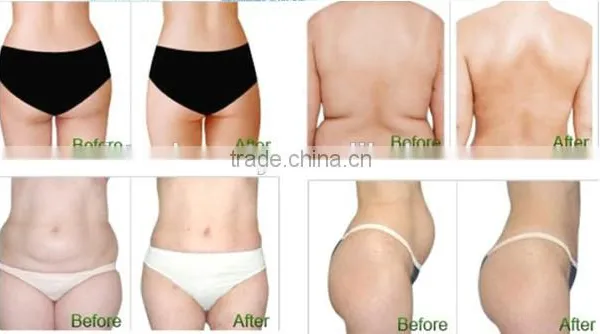 CE Fat Freezing Cryo Lipolysis Machine With 3 Different Size Handles photo-5