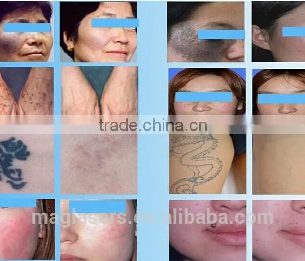 Skin Tightening Co2 Fractional Laser Skin Remove Neoplasms Rejuvenation Machine/laser Co2 Vaginal Treatment Machine 10.6um 8.0 Inch photo-6