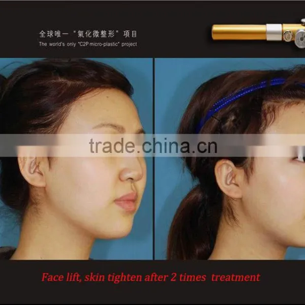 Hottest Facial Carboxytherapy, Carboxytherapy Dark Circle Removal, Skin Carboxytherapy Machine photo-6