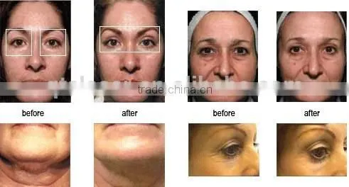 No-needle rf Skin Instrument for Facial Care Wrinkle Removal and Skin Tightening Whitening photo-4
