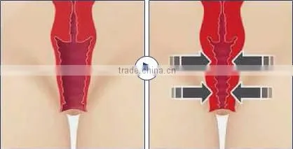 0.1-2J Portable Safety Color Touch Screen Vaginal Rejuvenation HIFU / HIFU Machine High Intensity Focused Ultrasound photo-6