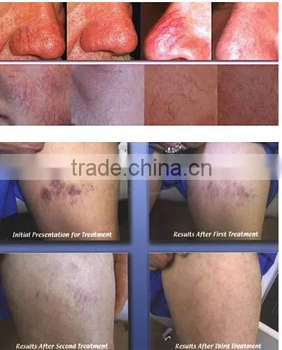 1500USD Promotion Price High Frequency Vein Needles/spider Vein Removal Machine photo-6