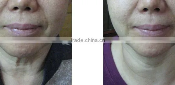 Portable New 2016 Hot Sale Hifu Anti-aging High Frequency Machine For Acne Skin Care Ultrasound Face Lift Machine Face Lifting photo-5