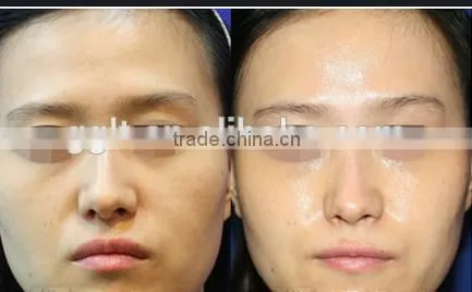 Best no Needle Cooling RF Skin Beauty Machine for Home Use photo-5