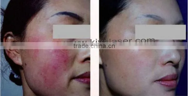 Upgraded Power Board! Vascular Removal Laser photo-5