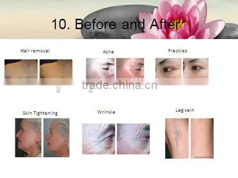 FDA IPL Hair Removal Pigmentation Removal Medical Apparatus photo-5