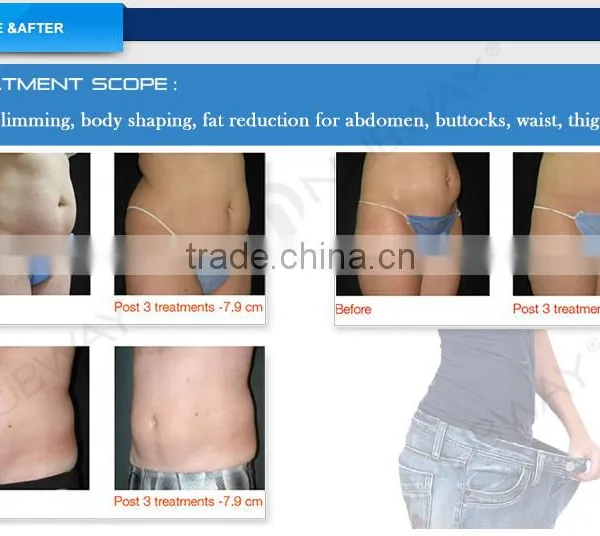 Nasolabial Folds Removal Non-surgical 500 000 Shots Warranty 1cm2 Spot High Frequency Machine Facial Size High Intensity Focused Ultrasound Ultrashape Hifu Body Slimming Machine High Frequency Esthetician Machine photo-6
