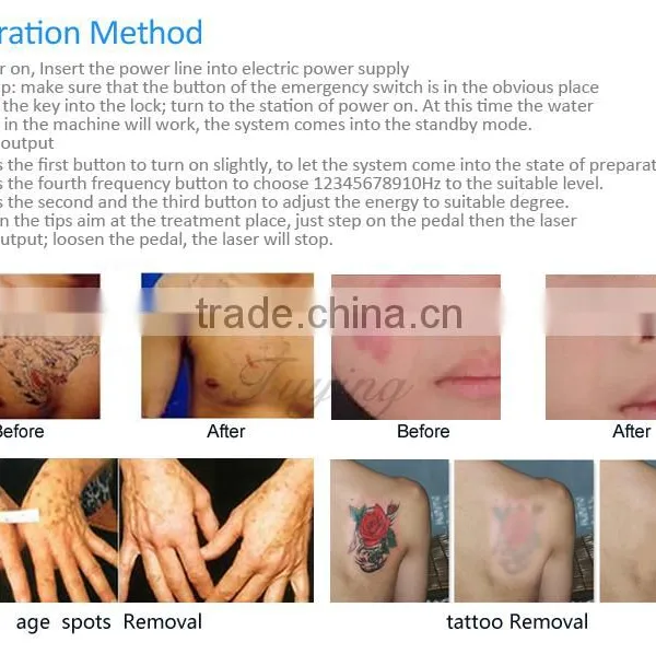 Home Tattoo Laser Machine Medical Laser 1 HZ Tatoo Removal Brown Age Spots Removal photo-4